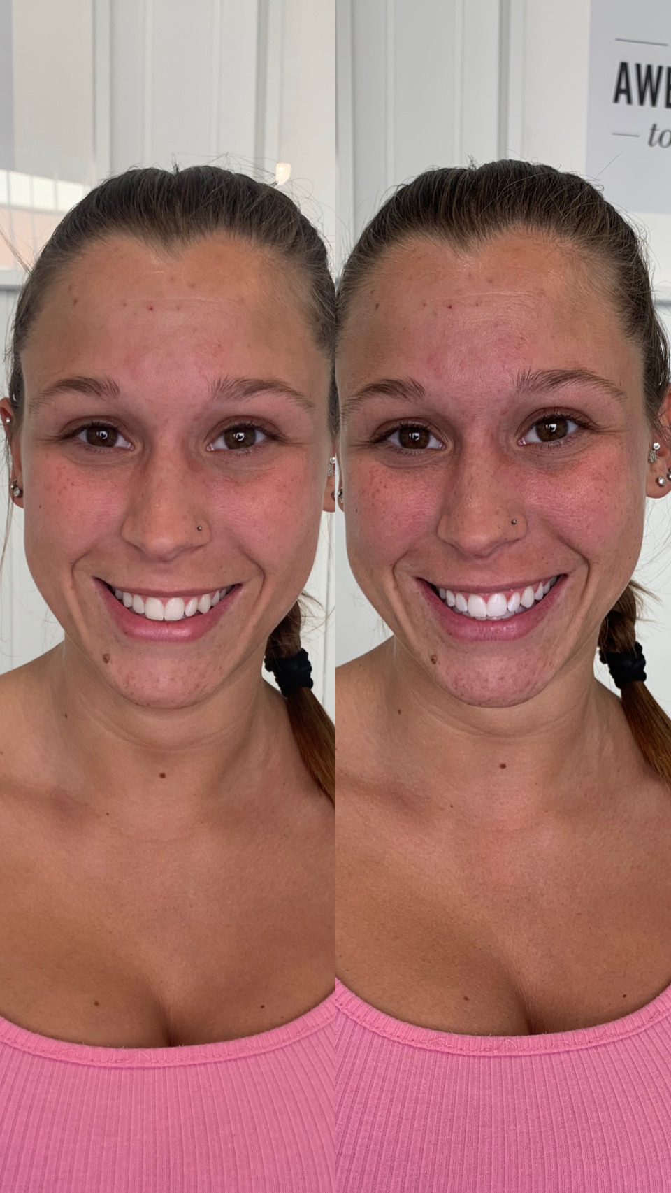Pearly Ergebnis kosmetische Zahnaufhellung